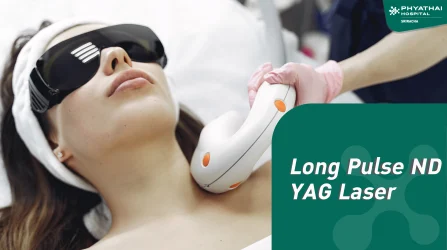 Long Pulse ND YAG Laser